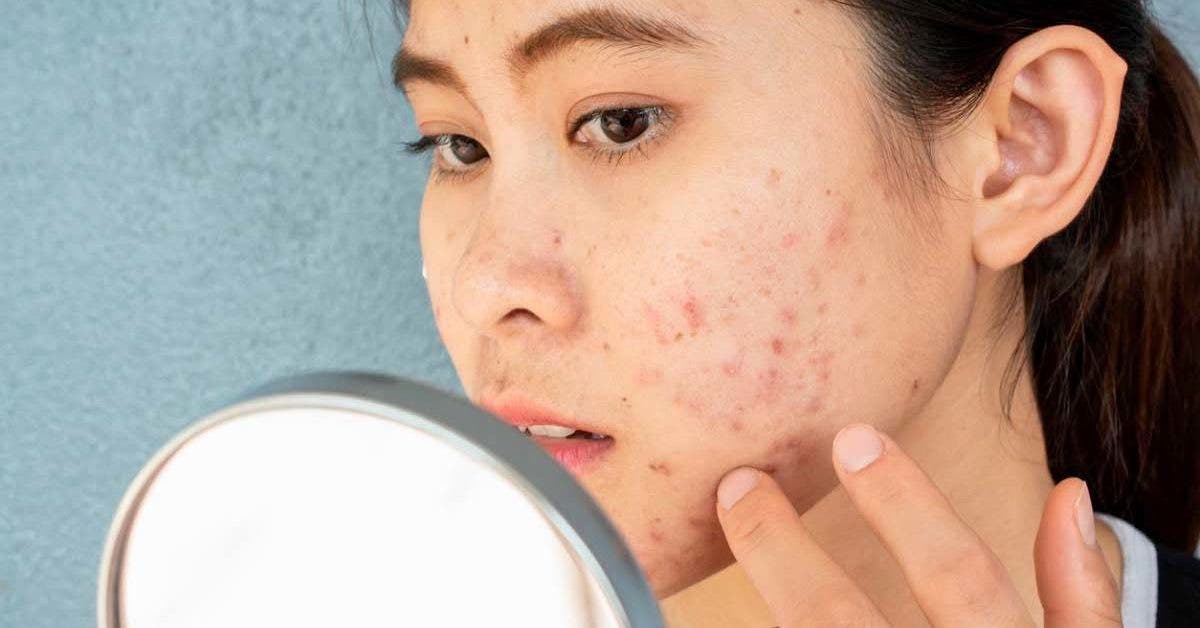 Comment traiter une peau à tendance acnéique ?