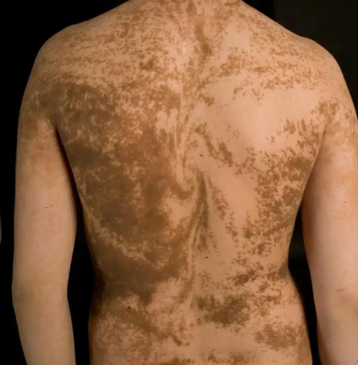 Lignes de Blaschko : votre corps est tapissé de motifs invisibles à l’oeil nu