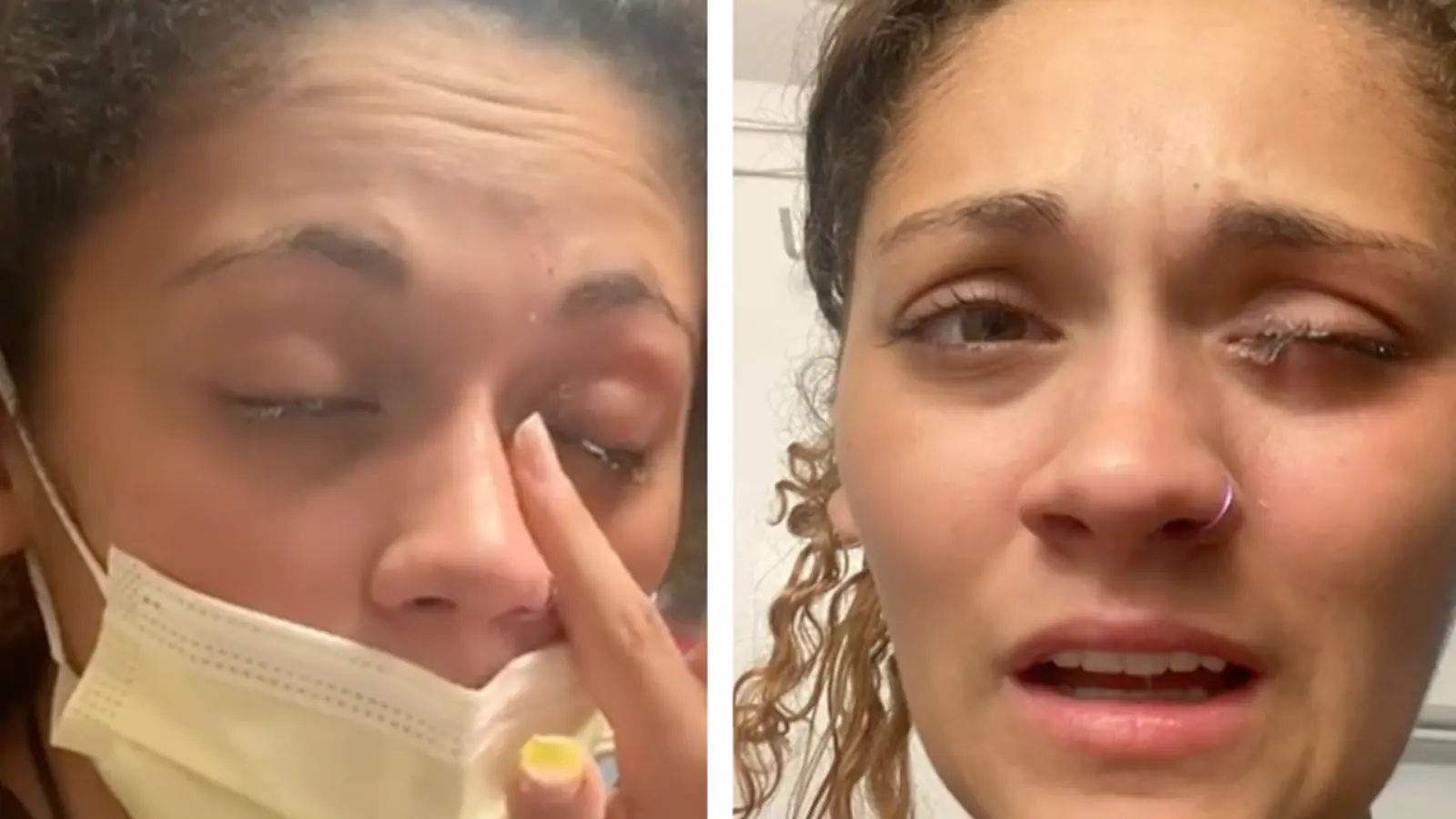 Une jeune femme confond de la colle avec des gouttes pour les yeux et se retrouve à l'hôpital